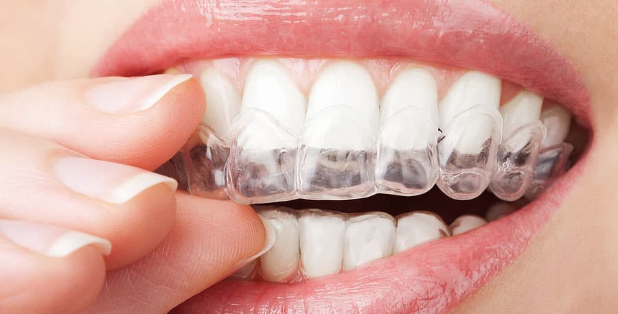 cosmetic teeth whitening img