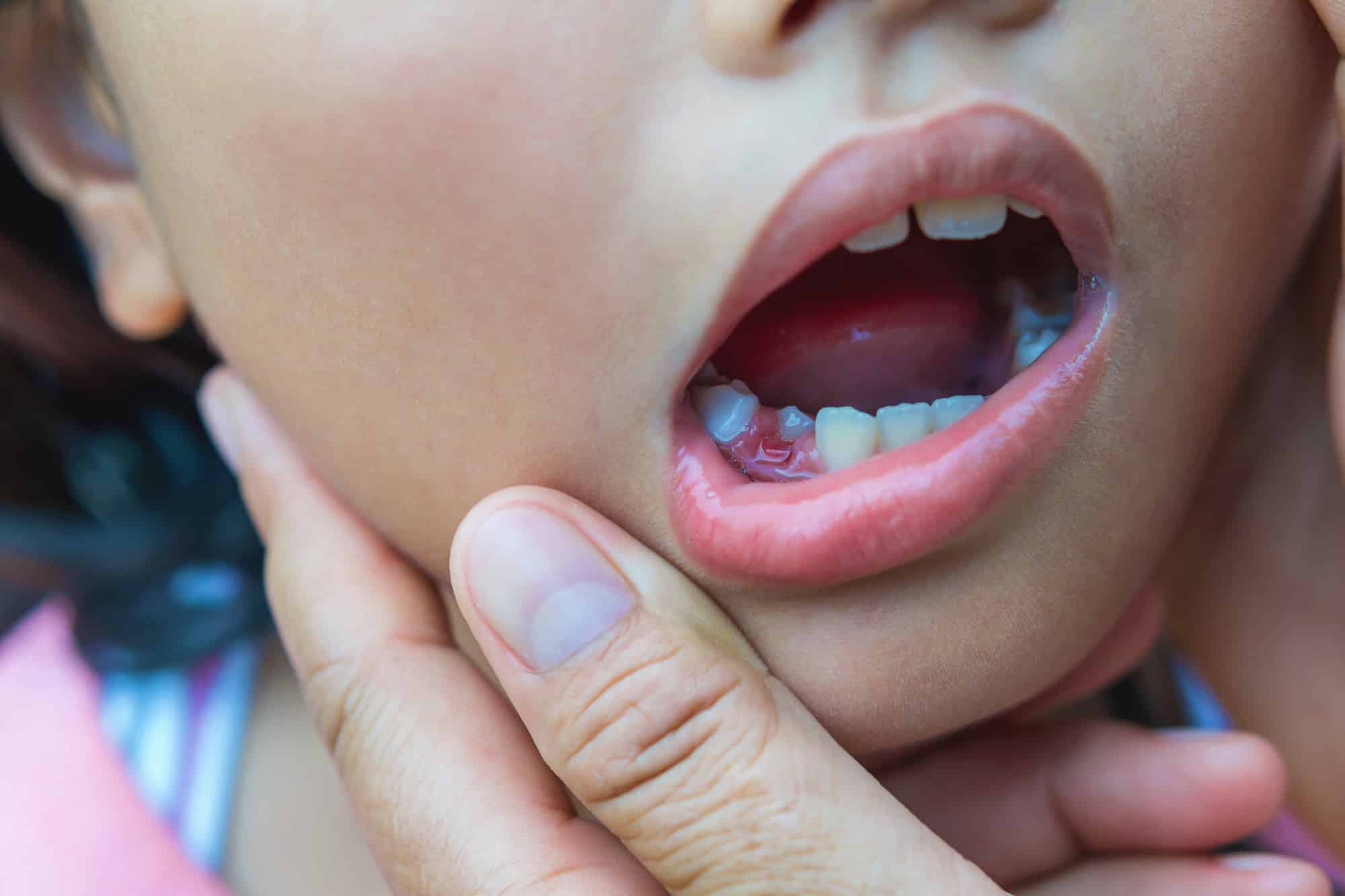 baby teeth not falling out