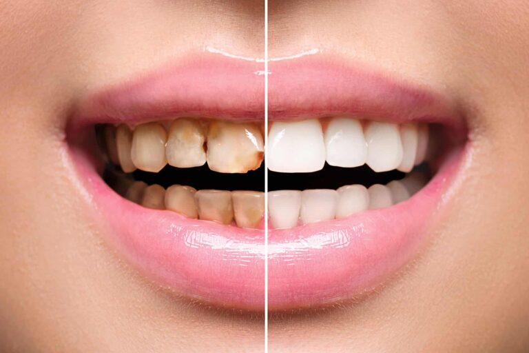 Womans teeth before and after