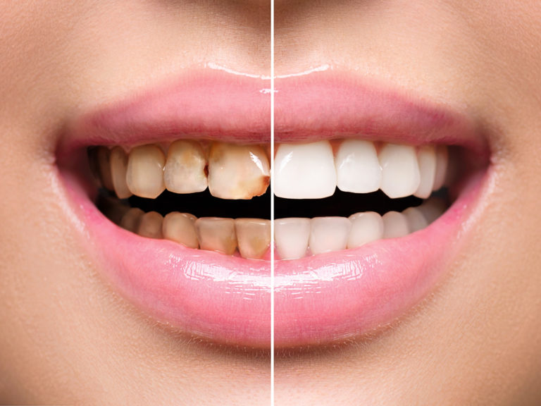 Womans teeth before and after