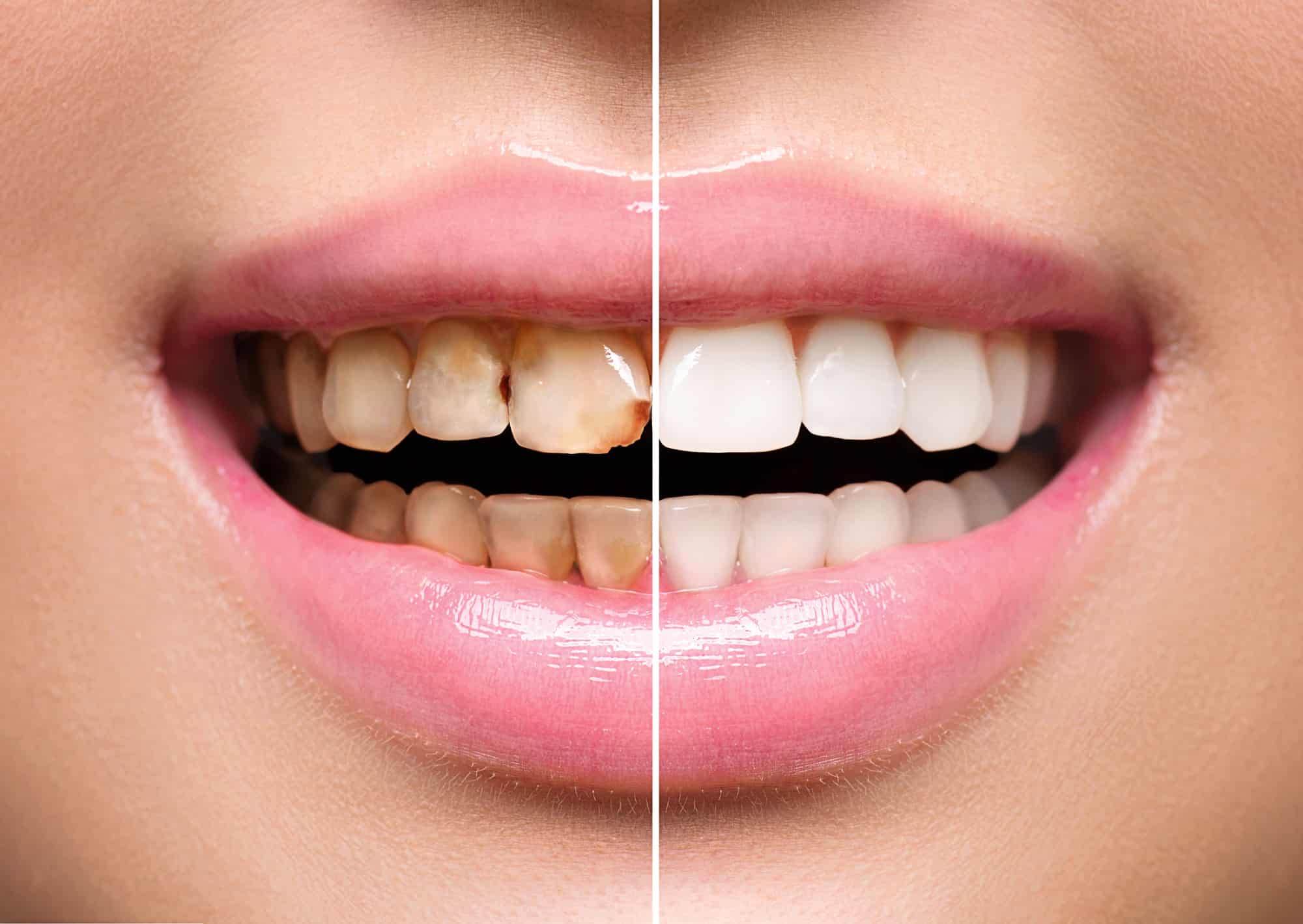 Тигразубик. Отбеливание передних зубов. Эстетическая стоматология. Отбеливание зубов в стоматологии.